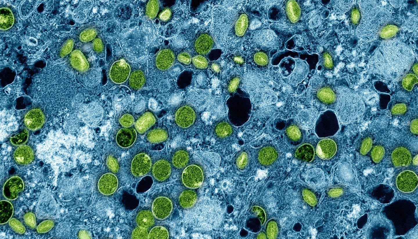 Neue Mpox-Variante Klade Ib erstmals in Deutschland nachgewiesen: RKI beruhigt, keine erhöhte Gefahr!