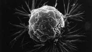 Brustkrebszelle unter einem Raster­elektronen­mikroskop