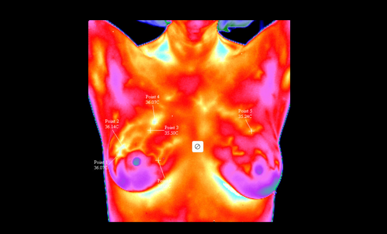 Neue Hoffnung für Brustkrebspatientinnen: Heidelberger Forscher verlängern mit personalisierter Therapie das Leben deutlich Neue Hoffnung für Brustkrebspatientinnen: Heidelberger Forscher verlängern mit personalisierter Therapie das Leben deutlich