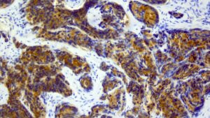 Prostatakrebs: Neue Heidelberger Kombi-Therapie macht Hoffnung