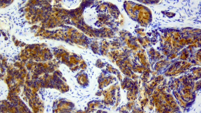 Prostatakrebs: Neue Heidelberger Kombi-Therapie macht Hoffnung