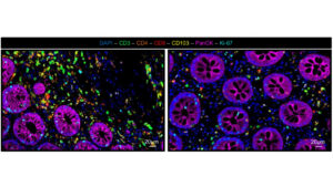 Immunfluoreszenz-Aufnahmen von entzündetem Darmgewebe vor und nach einer Photopherese